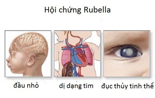 Rubella nguy hiểm như thế nào?bé trong suốt thời kì