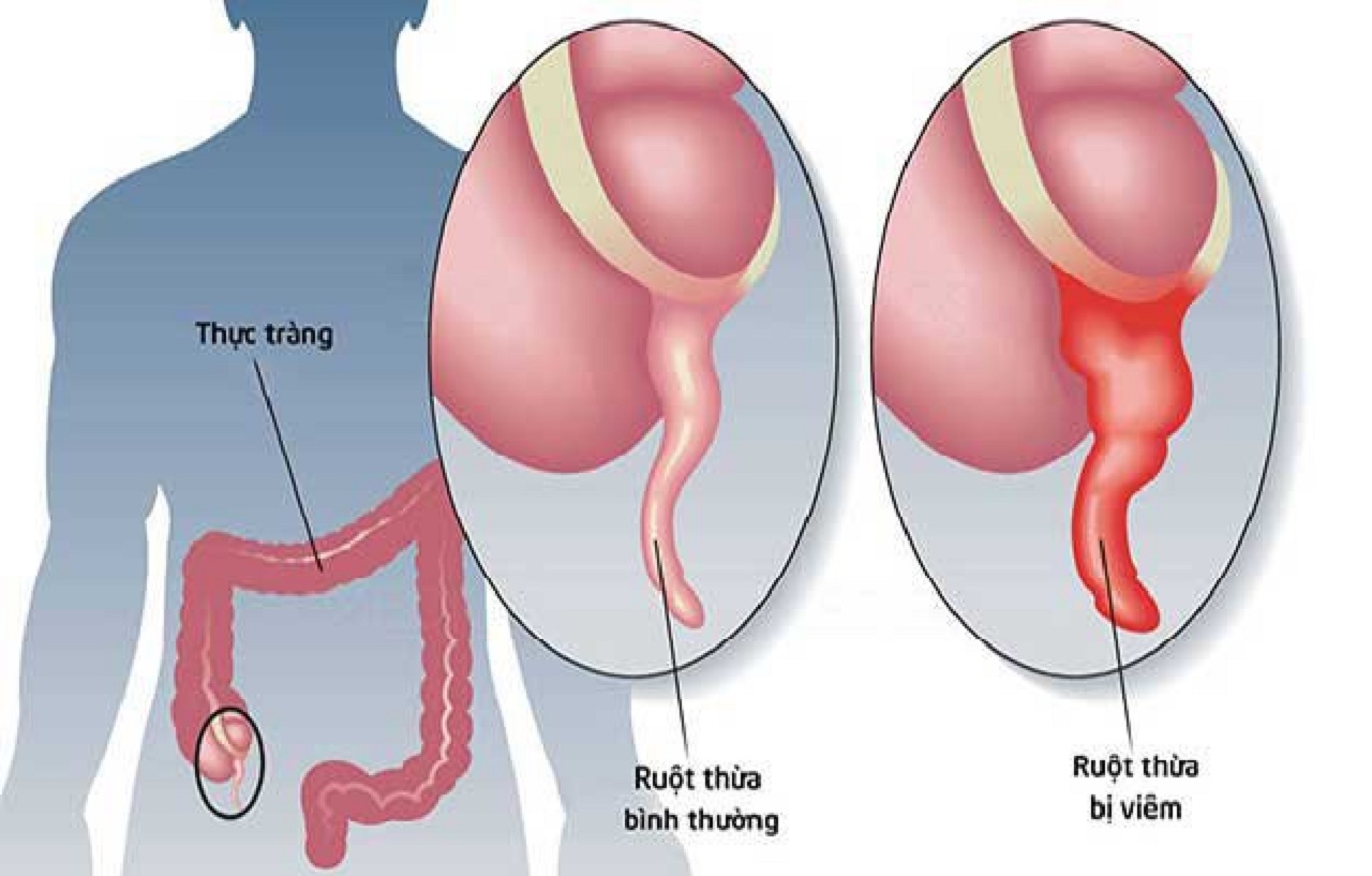 Ruột thừa: Chức năng và tình trạng viêm ruột thừa