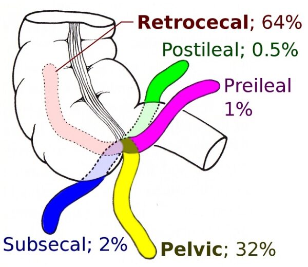 Ruột thừa là gì? Tại sao viêm ruột thừa?