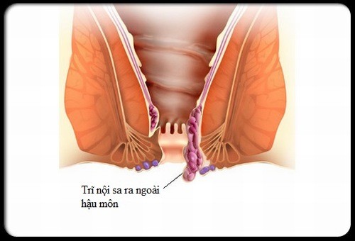 Sa búi trĩ có nguy hiểm không? phương pháp nào hiệu quả