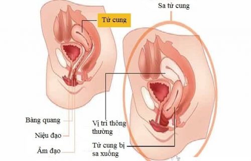 Sa ruột sau sinh