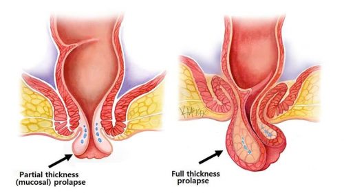 Sa trực tràng có nguy hiểm không?