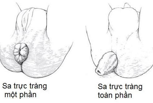 Sa trực tràng ở trẻ em khi nào cần phải phẫu thuật?