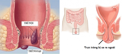 Sa trực tràng và cách điều trị