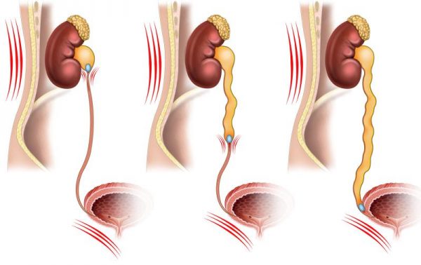 Sạch sỏi niệu quản sau 30 phút với phương pháp tán sỏi