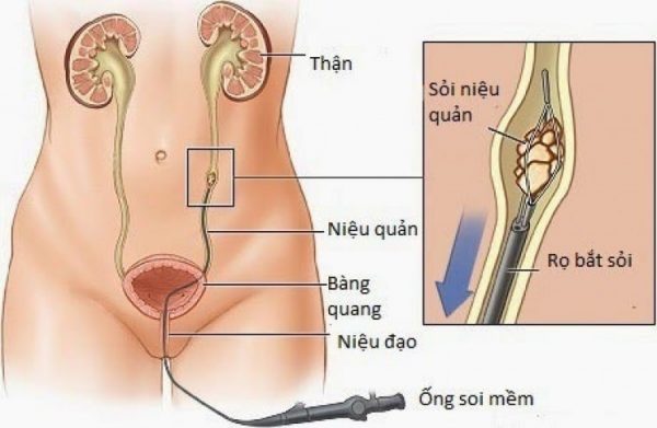 Tán sỏi nội soi ngược dòng là phương pháp bác sĩ đưa ống nội soi qua đường tự nhiên (đường tiểu) vào vị trí có sỏi để "bắn phá" sỏi bằng laser (ảnh minh họa)