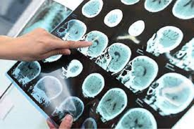 Sai lầm khi điều trị bệnh Alzheimer ở người cao tuổi