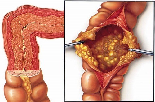 Sai lầm khiến viêm đại tràng tái phát