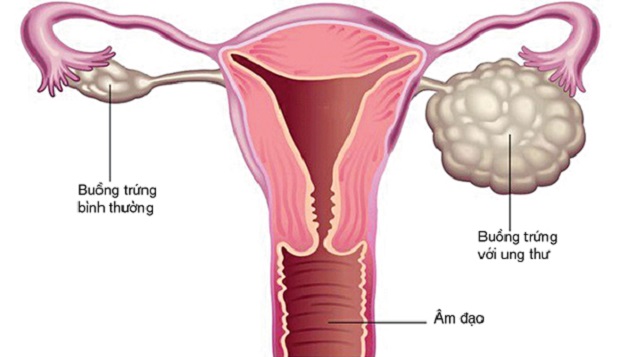 Sàng lọc ung thư buồng trứng như thế nào?