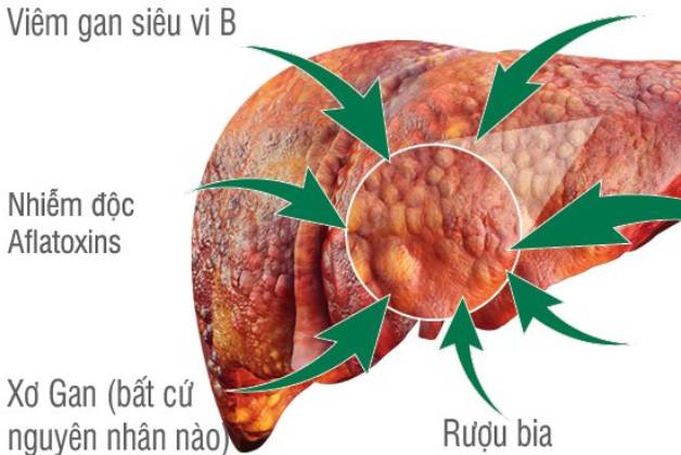 Sàng lọc ung thư gan ngay khi bạn thấy những dấu hiệu này