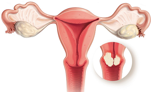 Sau mổ polyp cổ tử cung cần chú ý gì?