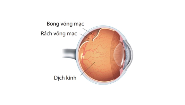 Sau phẫu thuật bong võng mạc cần chú ý điều gì?