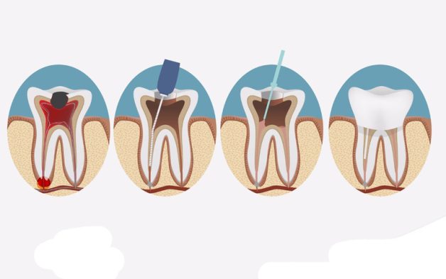 Sâu răng ăn vào tủy – Cẩn trọng tránh biến chứng nặng