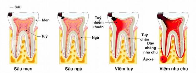 Sâu răng để lâu: Hậu quả nghiêm trọng hơn bạn nghĩ!