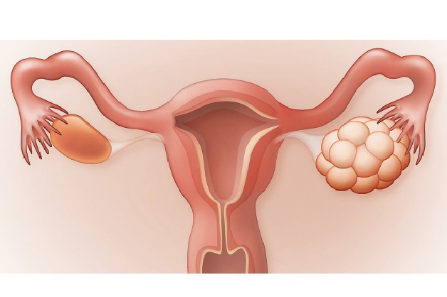 Siêu âm buồng trứng có nhiều nang nhỏ, bệnh gì?