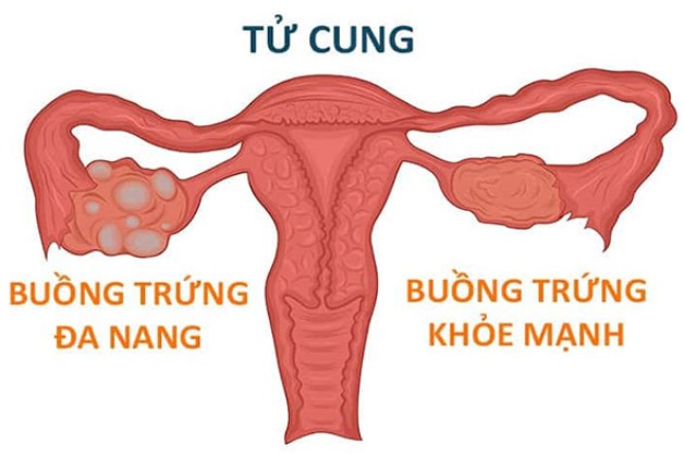 Siêu âm buồng trứng có thể phát hiện được bệnh lý nào?