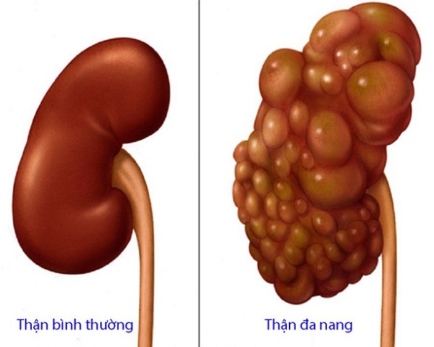 Siêu âm có biết suy thận không? Một số vấn đề khác