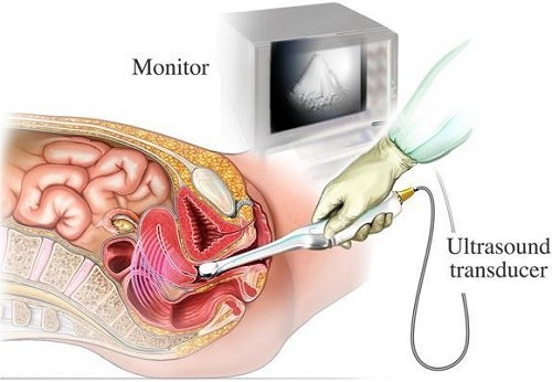 Siêu âm đầu dò có ĐAU không và có AN TOÀN không?