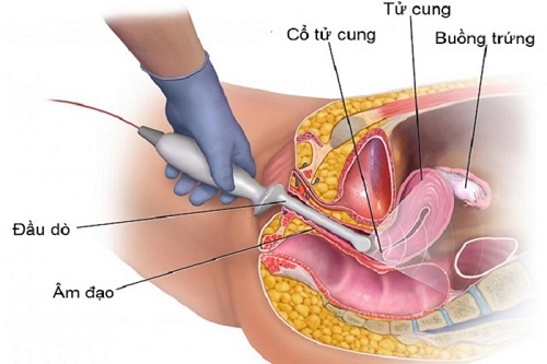 Siêu âm đầu dò có hại không, có ảnh hưởng đến thai nhi không?