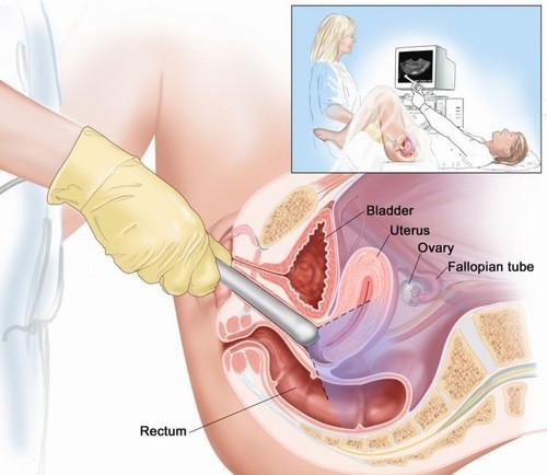 Siêu âm đầu dò có nguy hiểm không?