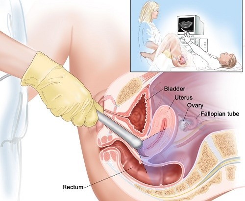 Siêu âm đầu dò để làm gì? kĩ thuật siêu âm chuyên sâu