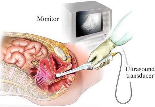 Siêu âm đầu dò là gì? cần thiết để thăm khám