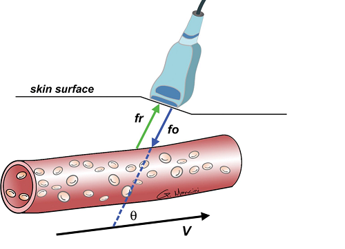 Siêu âm doppler mạch máu là gì?