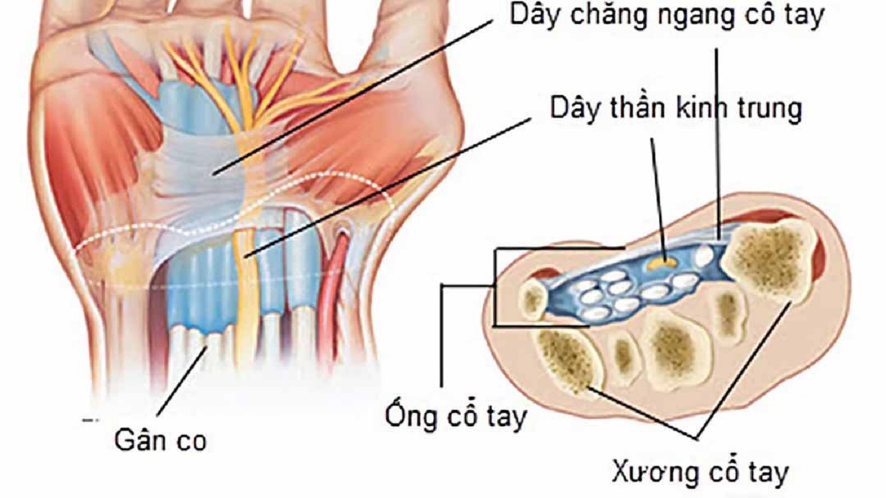 Siêu âm khớp cổ tay giúp phát hiện bệnh lý nào?