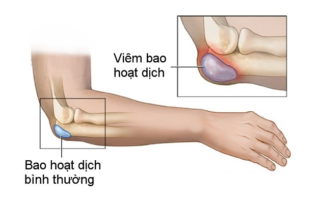 Siêu âm khớp khuỷu tay giúp phát hiện bệnh lý nào?