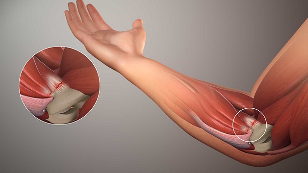 Siêu âm khớp khuỷu tay giúp phát hiện bệnh lý nào?