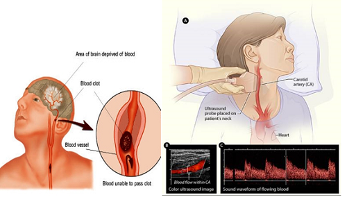 Siêu âm mạch máu mang lại lợi ích tuyệt vời