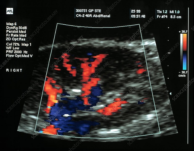 Siêu âm màu Doppler là gì, có nguy hiểm cho thai nhi không?