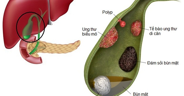 Siêu âm phát hiện có polyp ở túi mật phải làm sao?