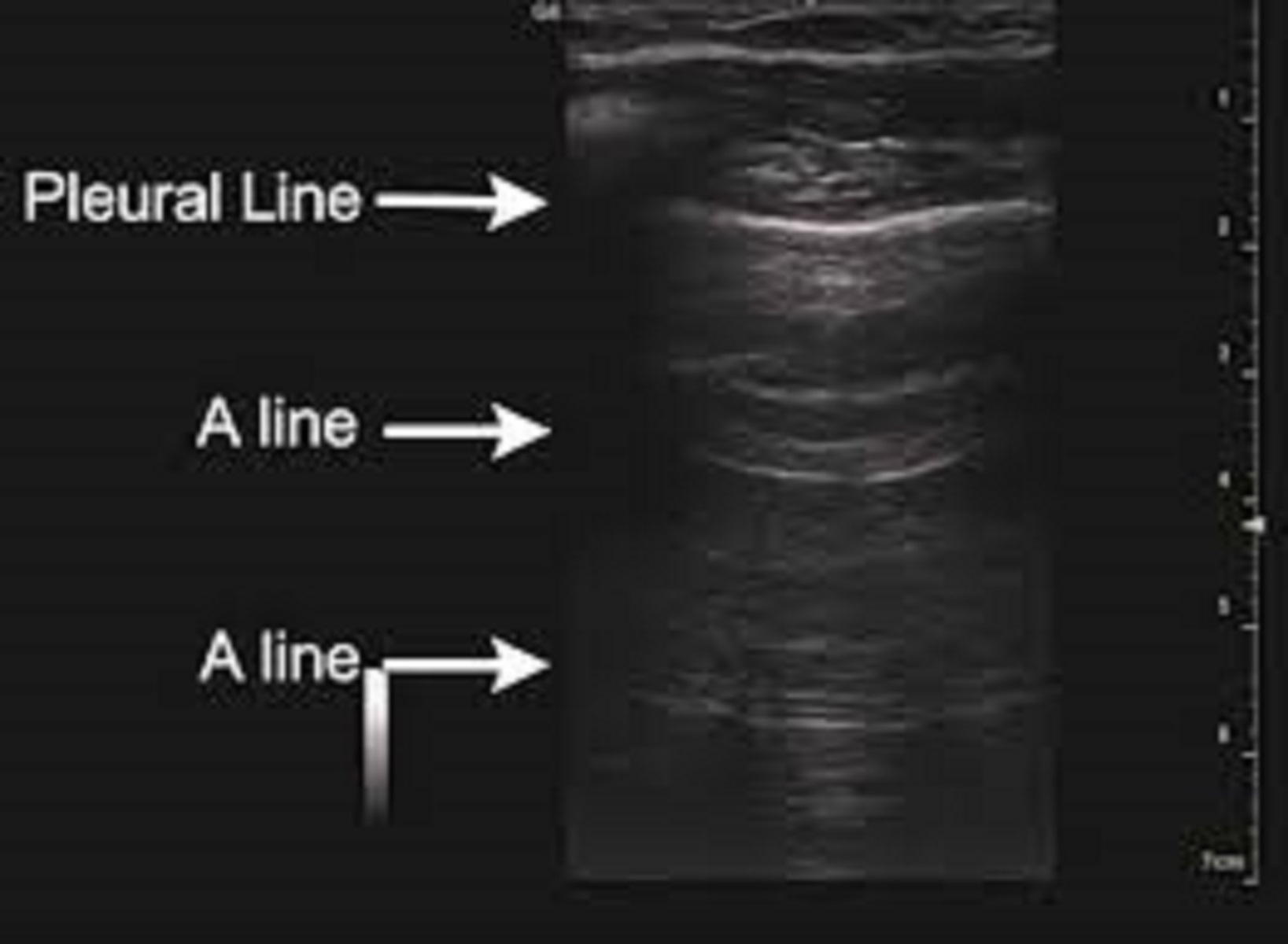 Siêu âm phổi và những ứng dụng thú vị trong chẩn đoán