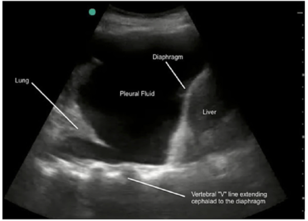 Siêu âm phổi và những ứng dụng thú vị trong chẩn đoán