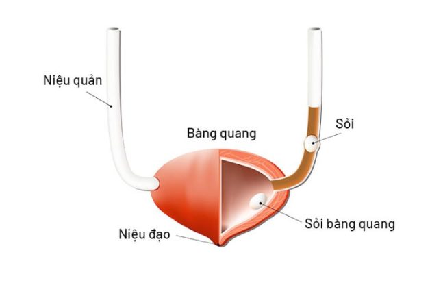 Siêu âm sỏi bàng quang – Cách sử dụng để chẩn đoán sỏi