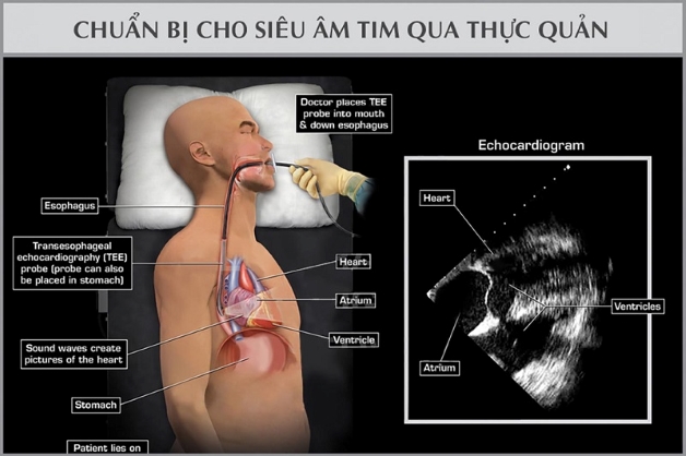 Siêu âm tim – Phương pháp chẩn đoán hình ảnh ưu việt