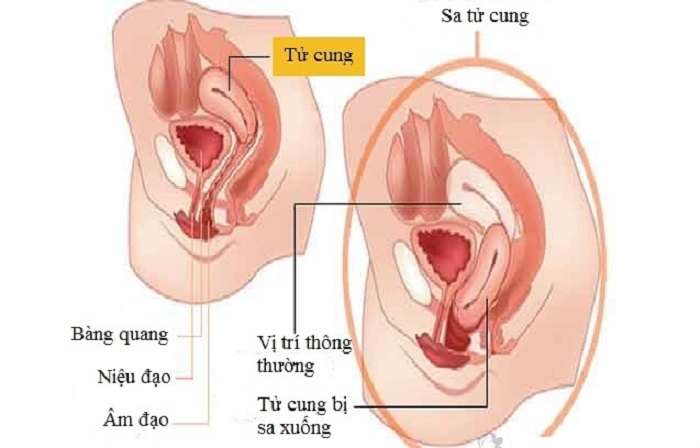 Sinh mổ và 4 điều mẹ bầu cần biết để tránh “mắc sai lầm”