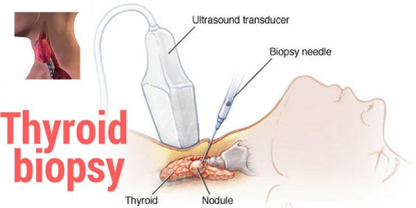 Sinh thiết: Bước cuối cùng để chẩn đoán ung thư