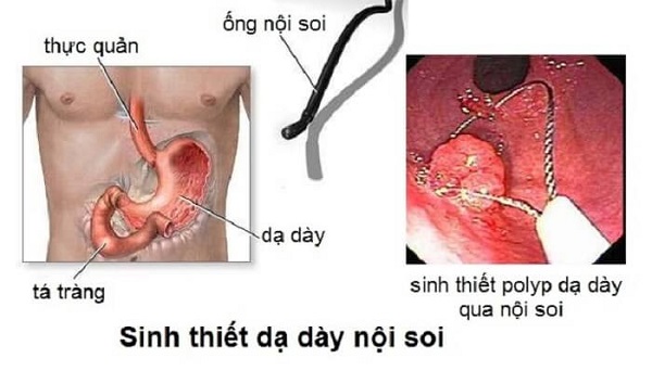 Sinh thiết polyp dạ dày – phát hiện chính xác ung thư