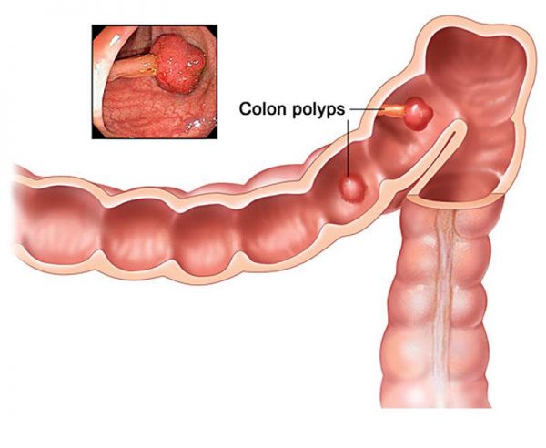 Sinh thiết polyp đại tràng