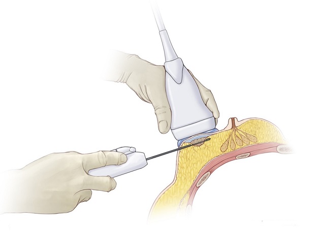 Sinh thiết u vú dưới hướng dẫn của siêu âm và lực hút chân không – không mổ, không sẹo, không nằm viện