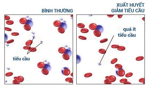 Số lượng tiểu cầu trong cơ thể nói lên điều gì?