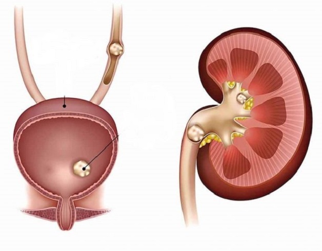 Sỏi bàng quang 10mm có nguy hiểm không, điều trị tán sỏi