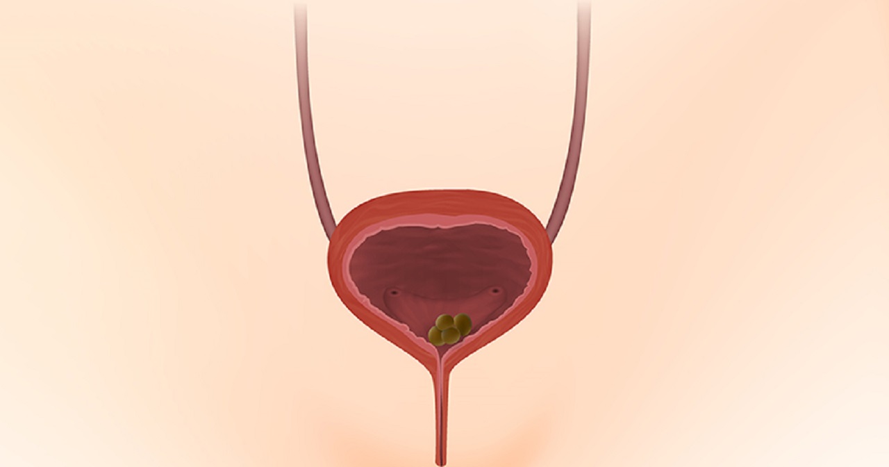 Sỏi bàng quang 7mm có nguy hiểm không và cách điều trị