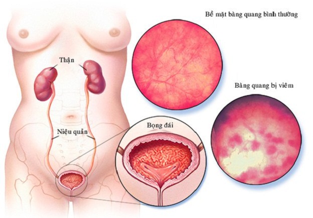 Sỏi bàng quang 7mm là lớn hay nhỏ và điều trị như thế nào?