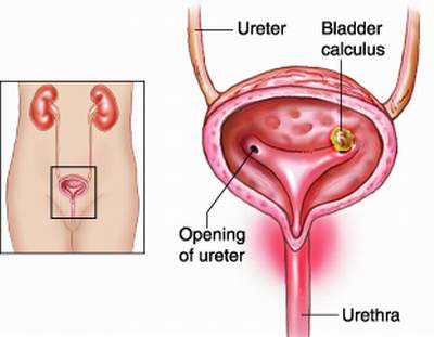 Sỏi bàng quang gây ra nhiễm trùng và nhiều biến chứng nguy hiểm khác