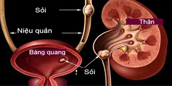 Sỏi bàng quang hình thành do yếu tố nào?