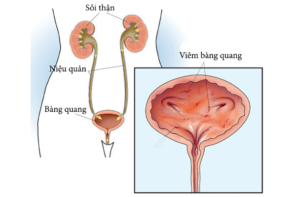 Sỏi bàng quang hình thành do yếu tố nào?