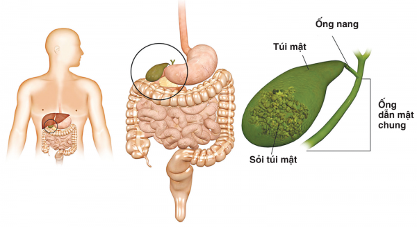 Sỏi bùn túi mật – tiền thân sỏi mật